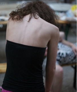 Anoressia Bambini Rimini